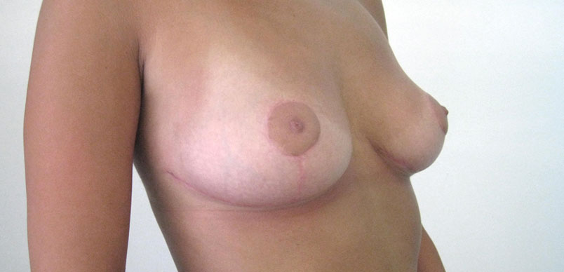 After breast asymmetry correction surgery